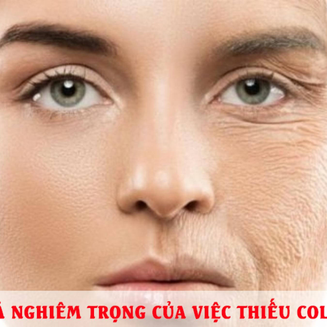 Hậu quả nghiêm trọng của việc thiếu collagen