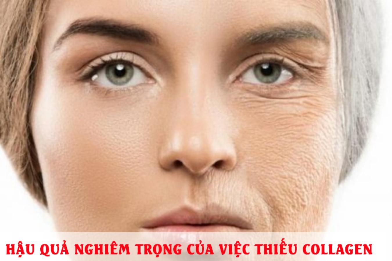 Hậu quả nghiêm trọng của việc thiếu collagen